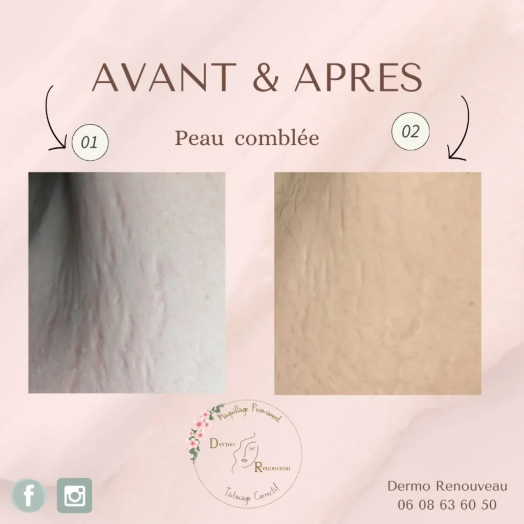 Dermo renouveau à Falaise correction des cicatrices et reconstruction des aréoles