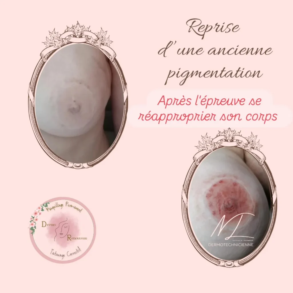 Dermo renouveau à Falaise correction des cicatrices et reconstruction des aréoles