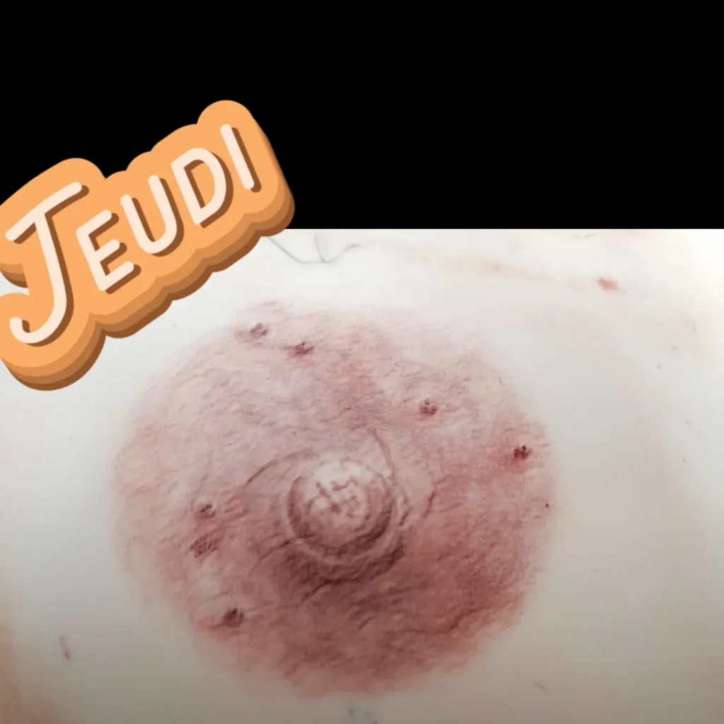 Dermo renouveau à Falaise correction des cicatrices et reconstruction des aréoles