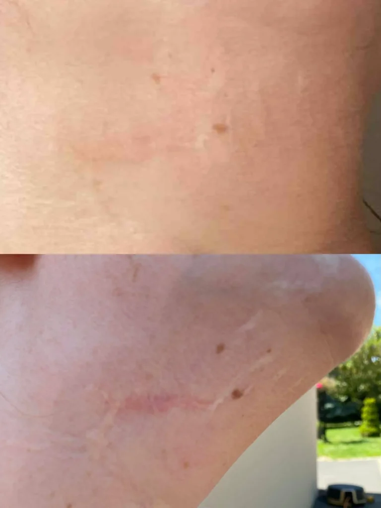 Dermo renouveau à Falaise correction des cicatrices et reconstruction des aréoles