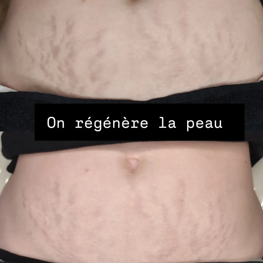 Dermo renouveau à Falaise correction des cicatrices et reconstruction des aréoles