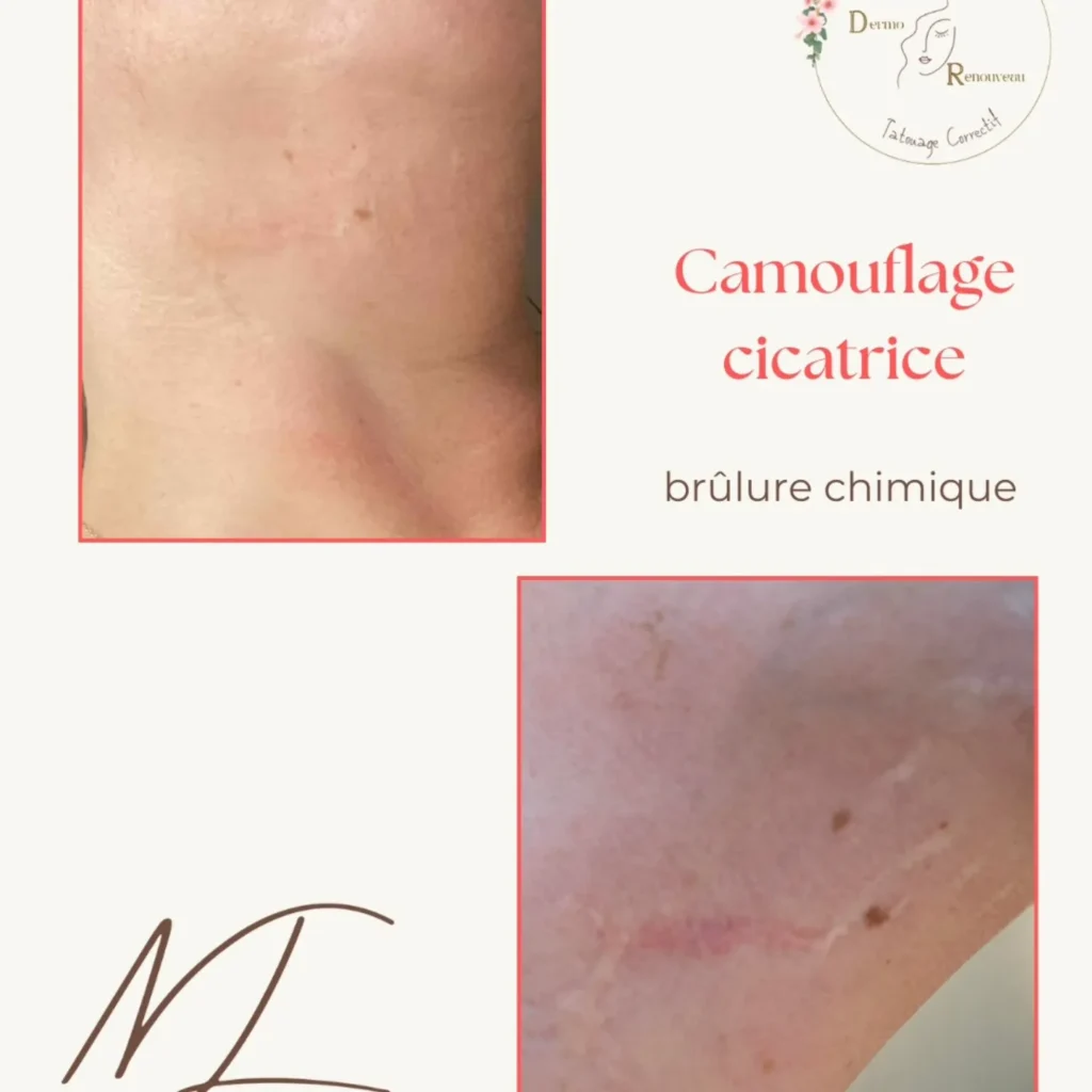Dermo renouveau à Falaise correction des cicatrices et reconstruction des aréoles