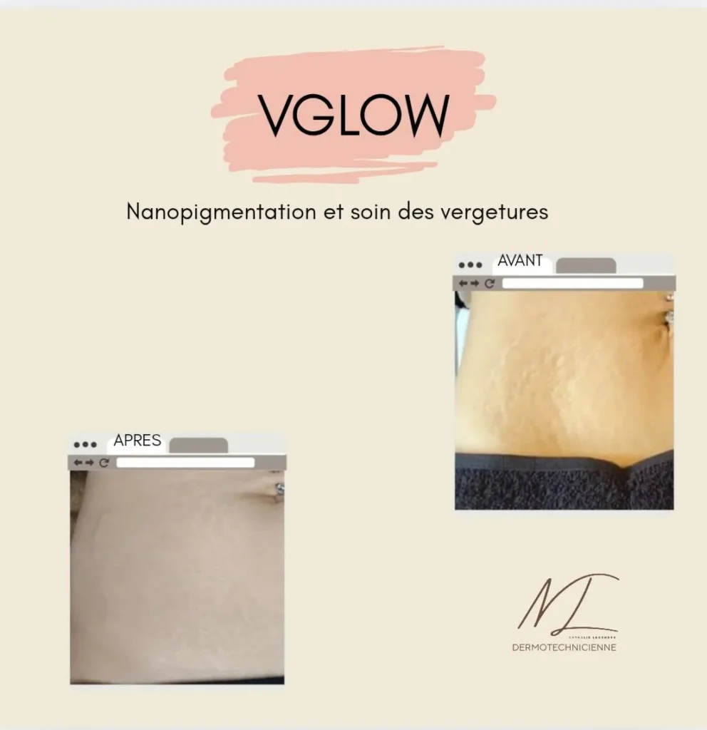 Dermo renouveau à Falaise correction des cicatrices et reconstruction des aréoles