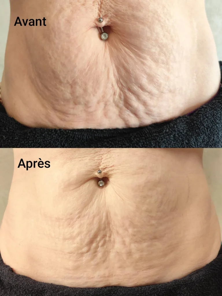 Dermo renouveau à Falaise correction des cicatrices et reconstruction des aréoles